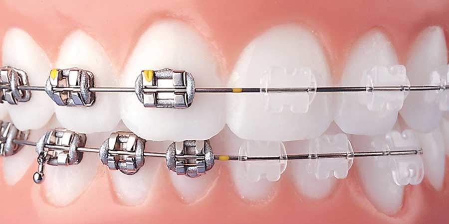 Ortodonti diş teli tedavisi