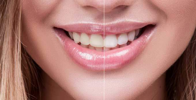 Evde doğal diş beyazlatma yöntemleri